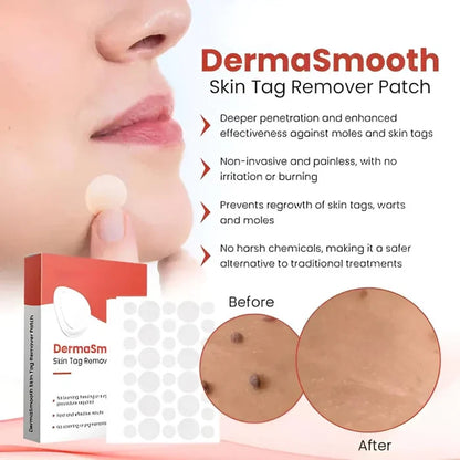 Skin Tag Removal